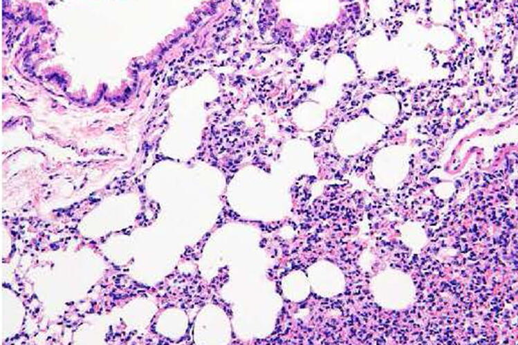 Purple stained lung cells from a mouse, showing large holes